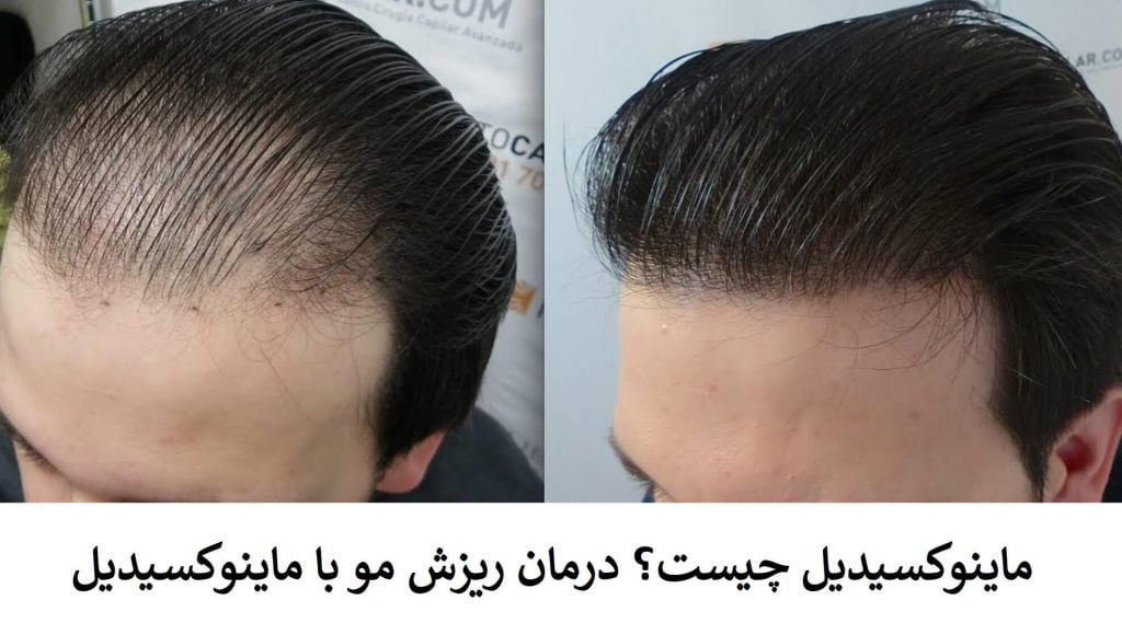 ماینوکسیدیل چیست؟ درمان ریزش مو با ماینوکسیدیل