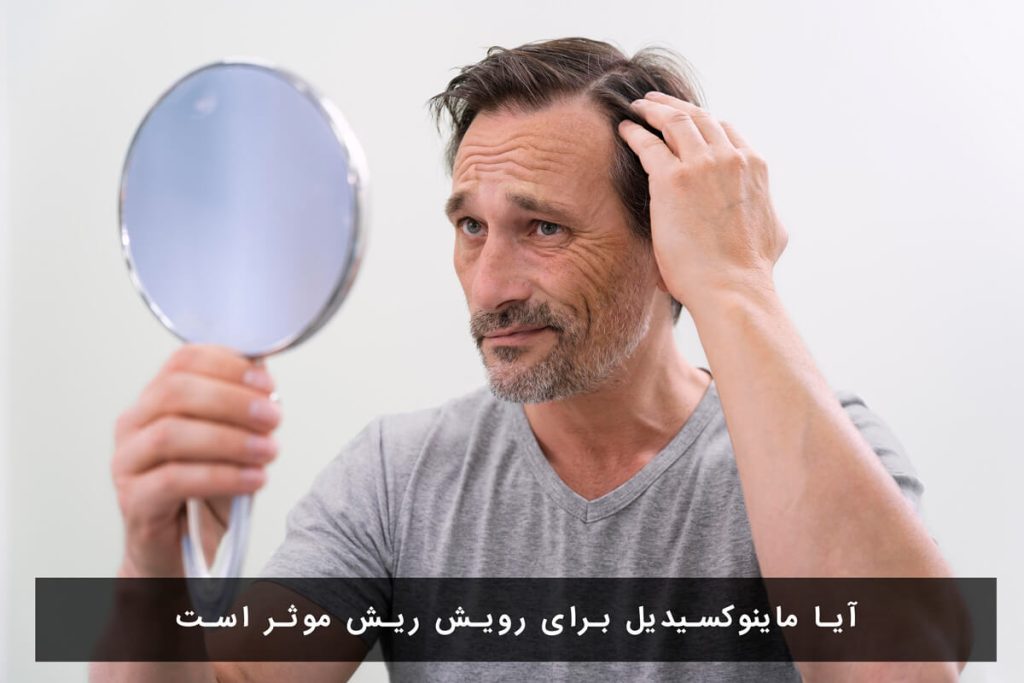 آیا ماینوکسیدیل برای رویش ریش موثر است